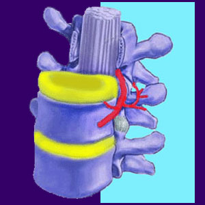 Nerve Compression Back Pain