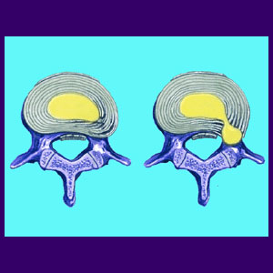 Annular Tear - Back Pain