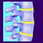 Facet Joint Arthrosis - Back Pain