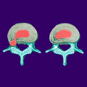 Herniated Discs - Back Pain