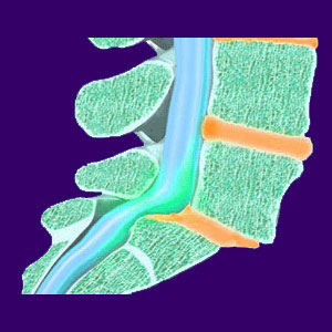 Retrolisthesis - Back Pain