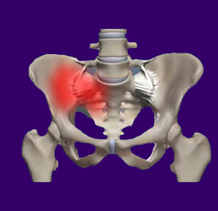 Sacroiliac Joint Injury - Back Pain