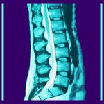 Spinal Canal Narrowing - Back Pain